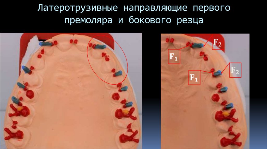 Латеротрузивные направляющие первого премоляра и бокового резца