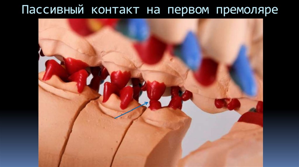 Пассивный контакт на первом премоляре