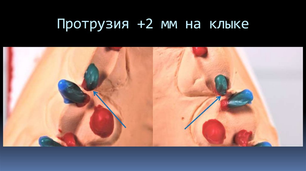 Протрузия +2 мм на клыке