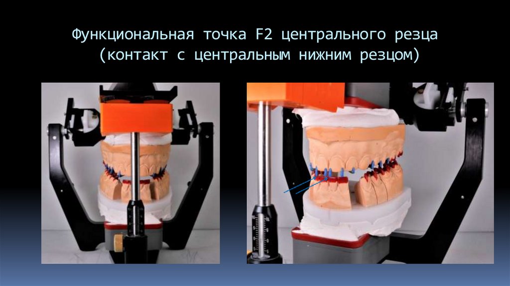 Функциональная точка F2 центрального резца (контакт с центральным нижним резцом)