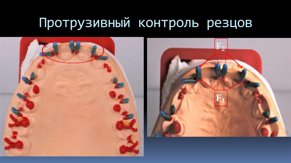 Протрузивный контроль резцов