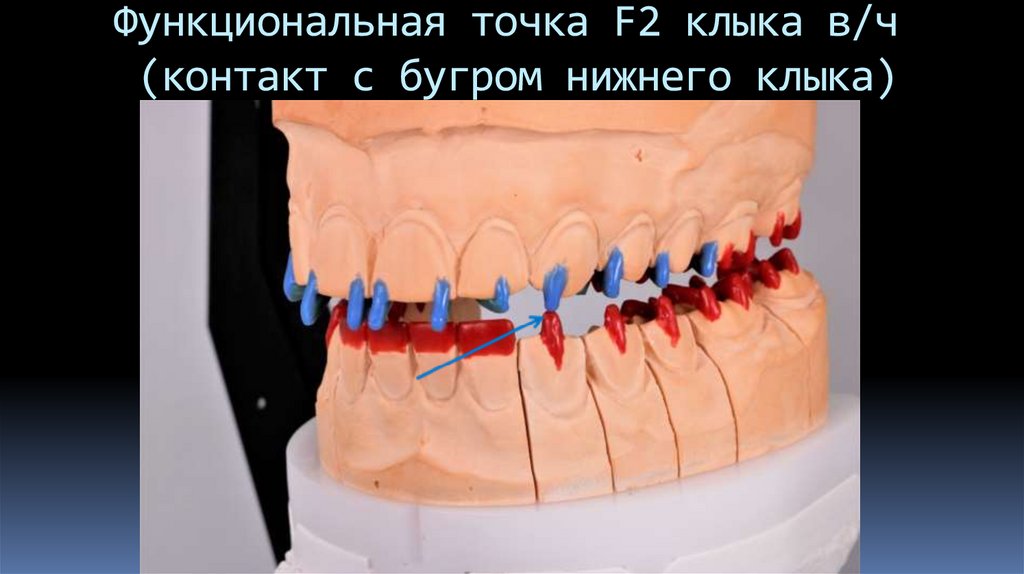 Функциональная точка F2 клыка в/ч (контакт с бугром нижнего клыка)