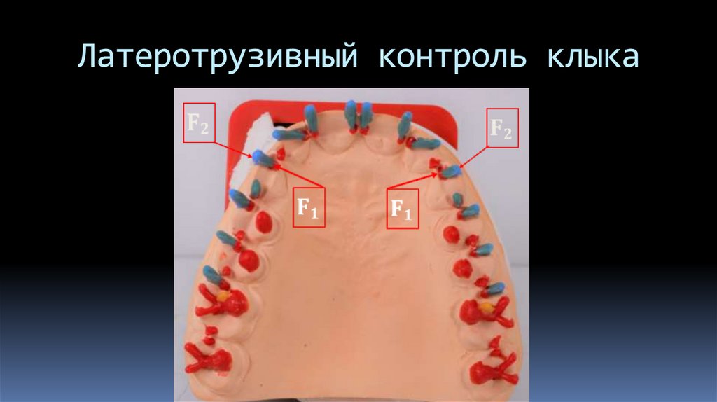 Латеротрузивный контроль клыка