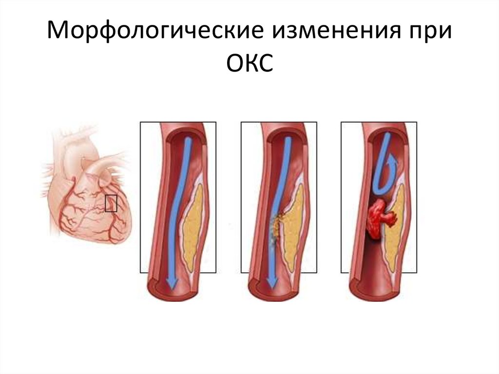 Морфологические изменения при ОКС