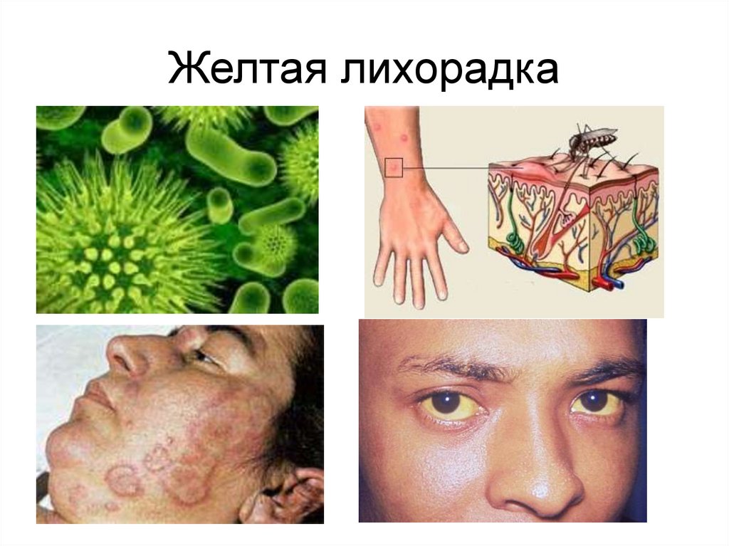 Желтая лихорадка