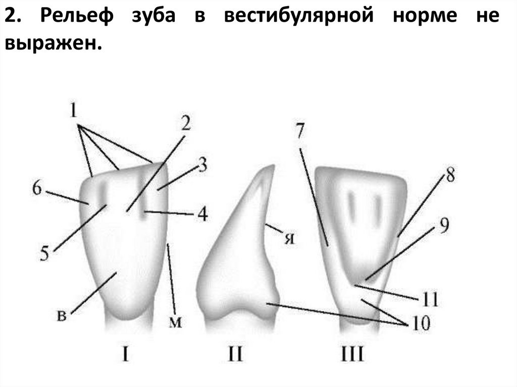 2. Рельеф зуба в вестибулярной норме не выражен.