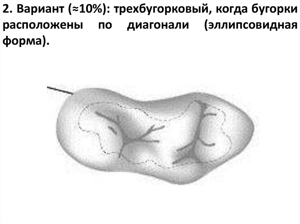 2. Вариант (≈10%): трехбугорковый, когда бугорки расположены по диагонали (эллипсовидная форма).