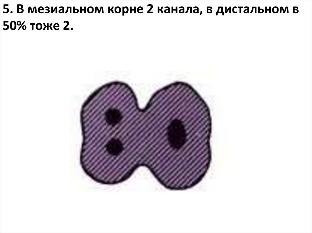 5. В мезиальном корне 2 канала, в дистальном в 50% тоже 2.