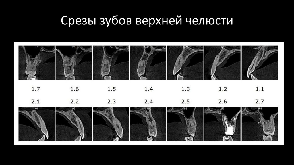 Срезы зубов верхней челюсти