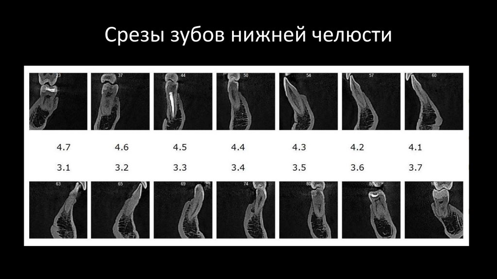 Срезы зубов нижней челюсти