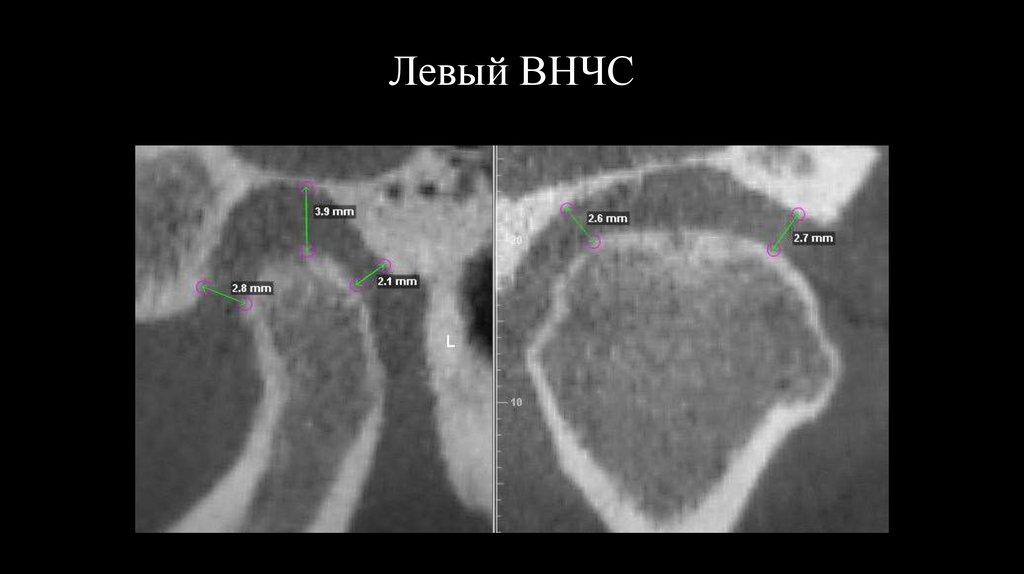 Левый ВНЧС