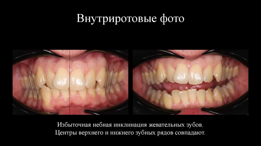 Внутриротовые фото