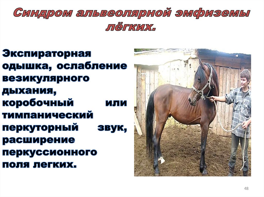 Синдром альвеолярной эмфиземы лёгких.