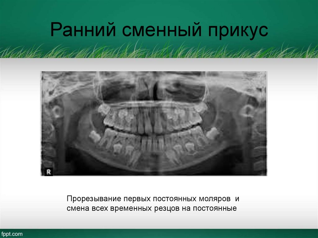 Ранний сменный прикус