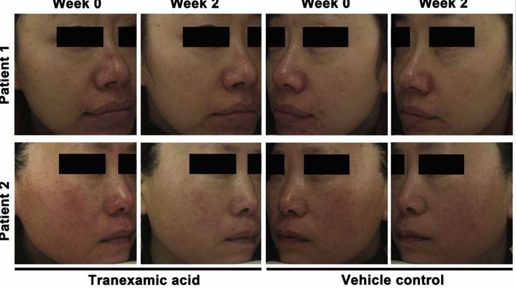 Is TXA a new option in rosacea treatment?