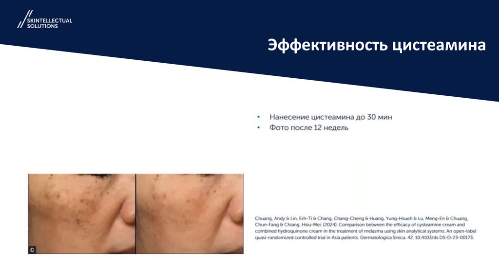 Эффективность цистеамина