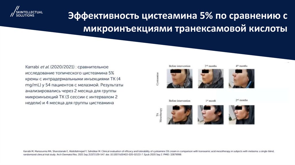 Эффективность цистеамина 5% по сравнению с микроинъекциями транексамовой кислоты