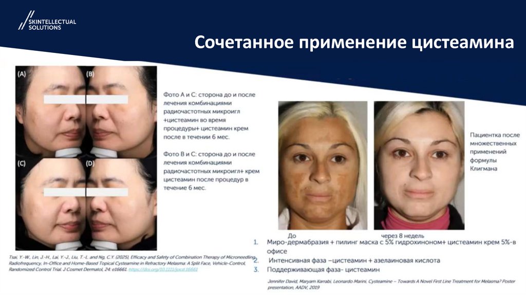 Сочетанное применение цистеамина