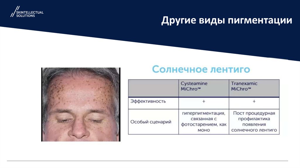 Другие виды пигментации