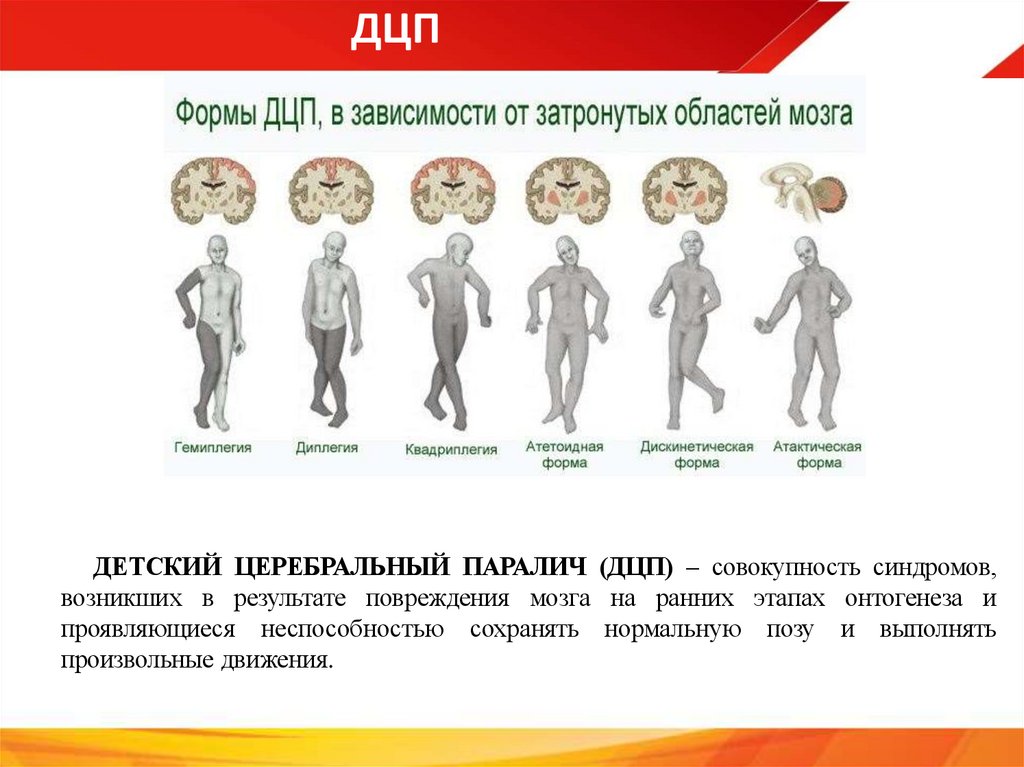 ДЦП