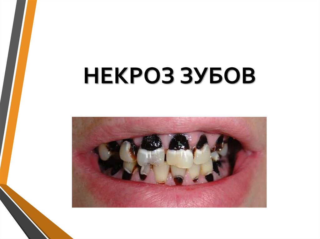 НЕКРОЗ ЗУБОВ