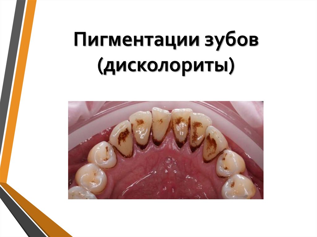 Пигментации зубов (дисколориты)