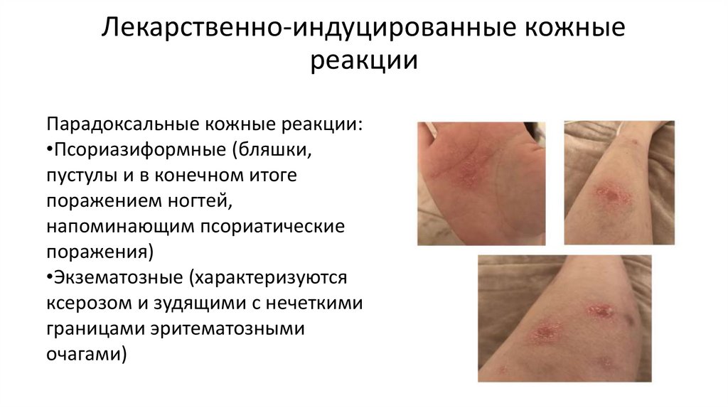 Лекарственно-индуцированные кожные реакции