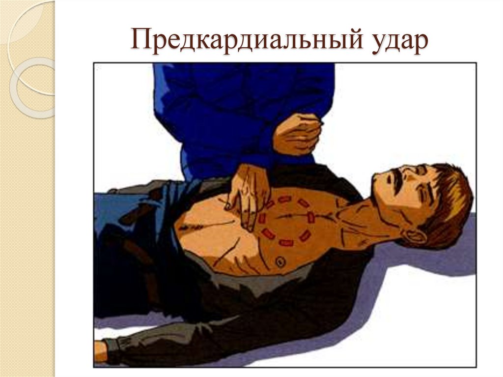 Предкардиальный удар