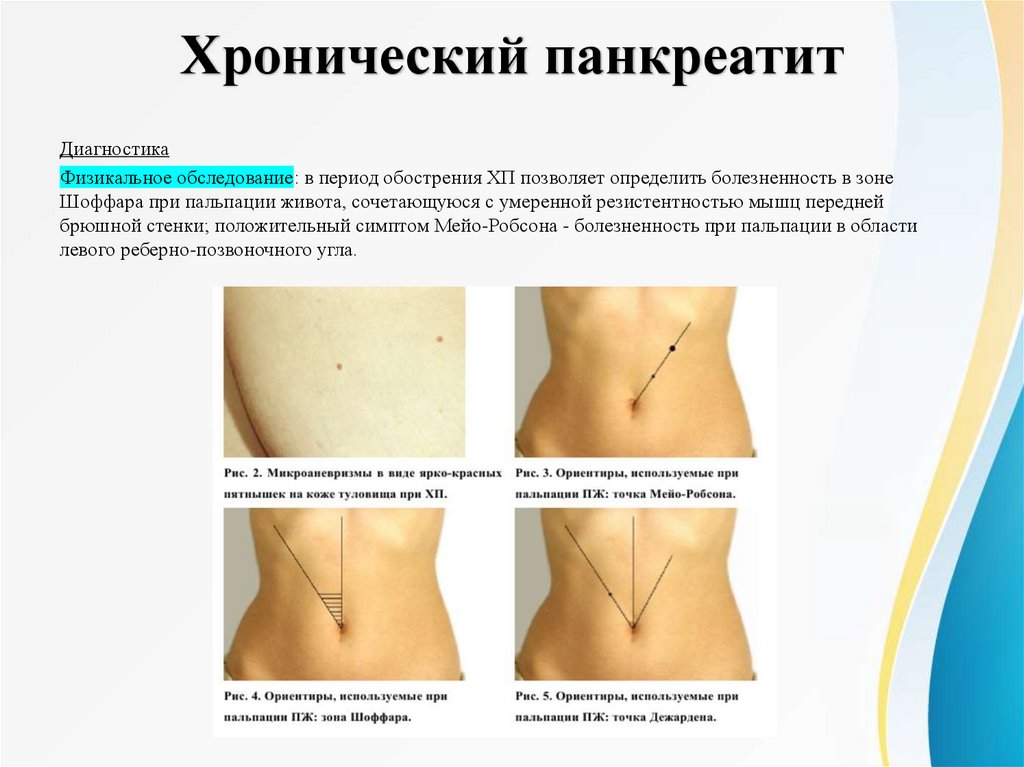 Хронический панкреатит