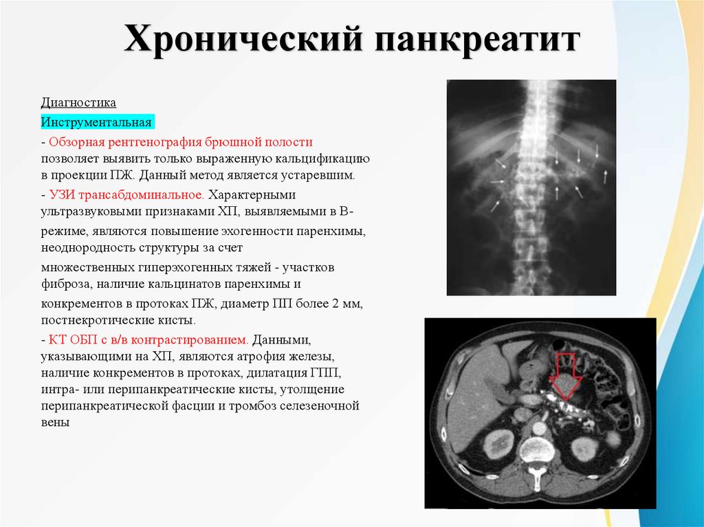 Хронический панкреатит