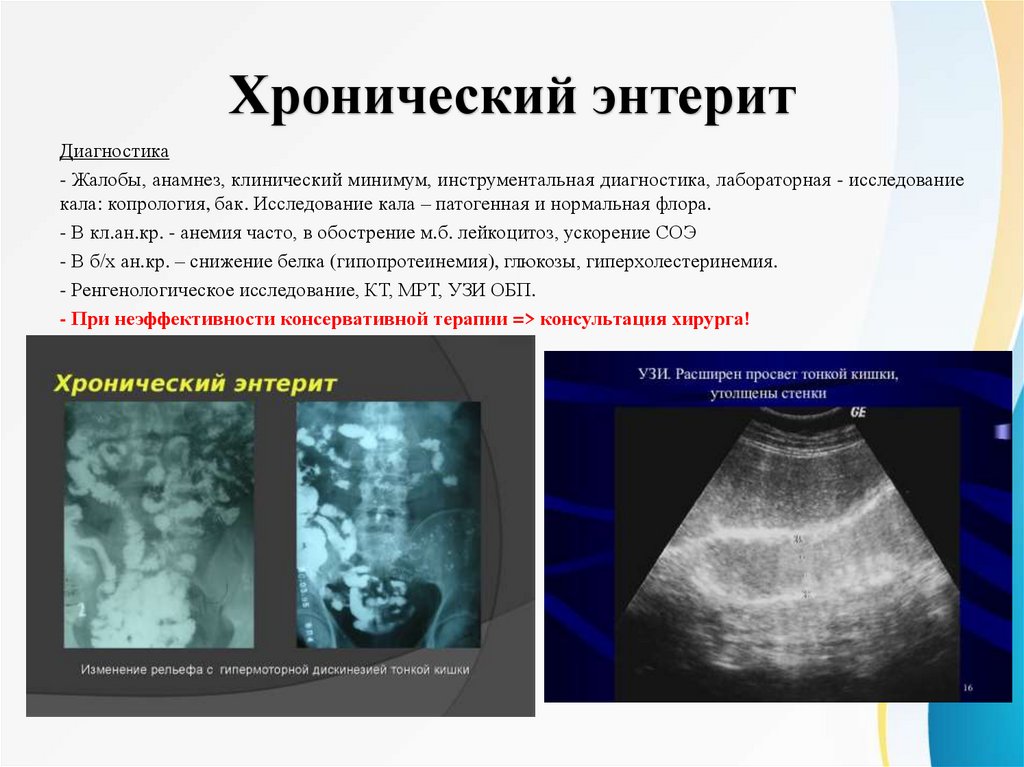 Хронический энтерит
