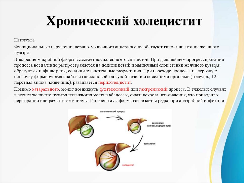 Хронический холецистит