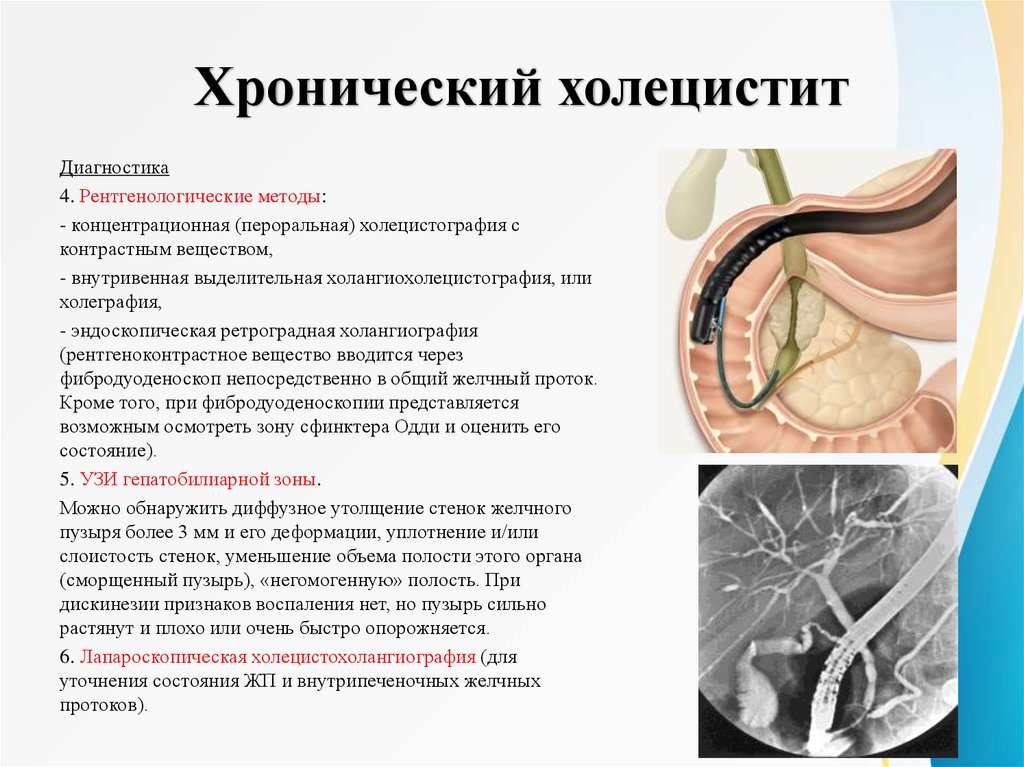 Хронический холецистит