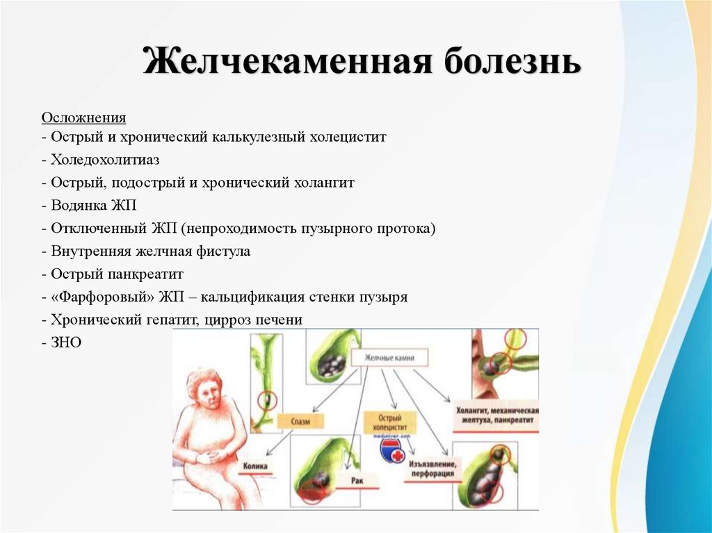 Желчекаменная болезнь