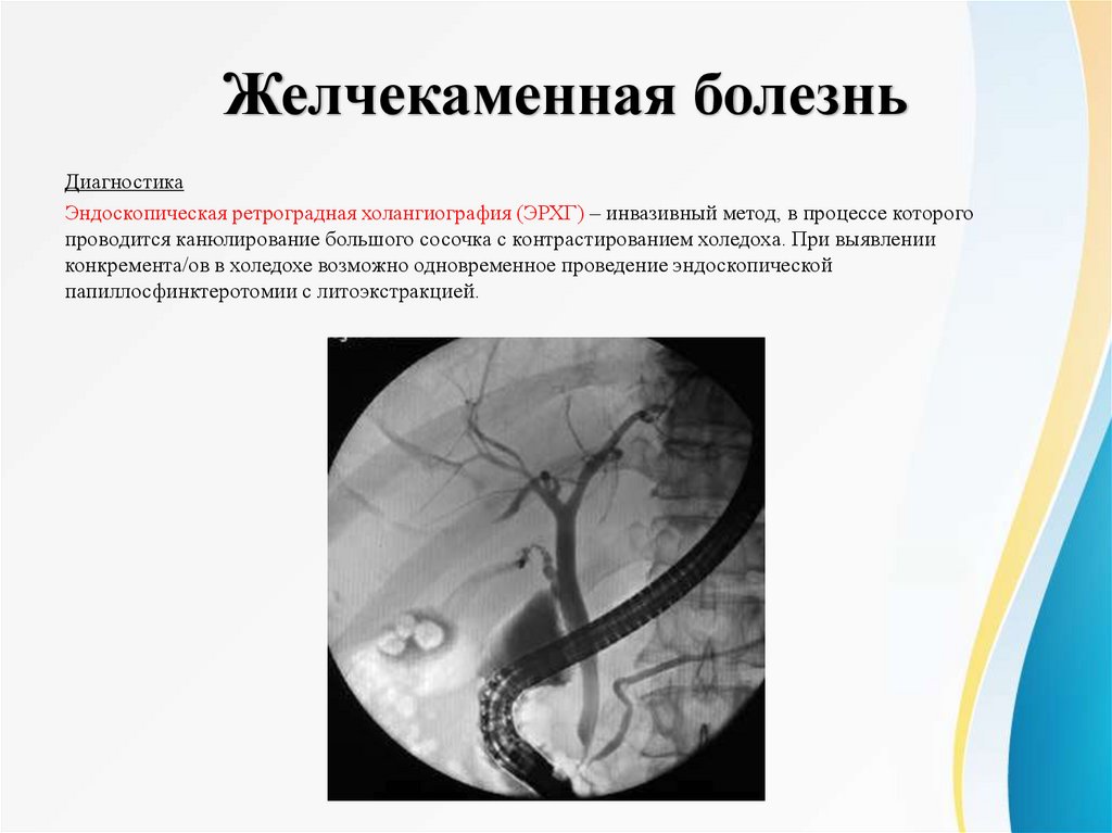 Желчекаменная болезнь