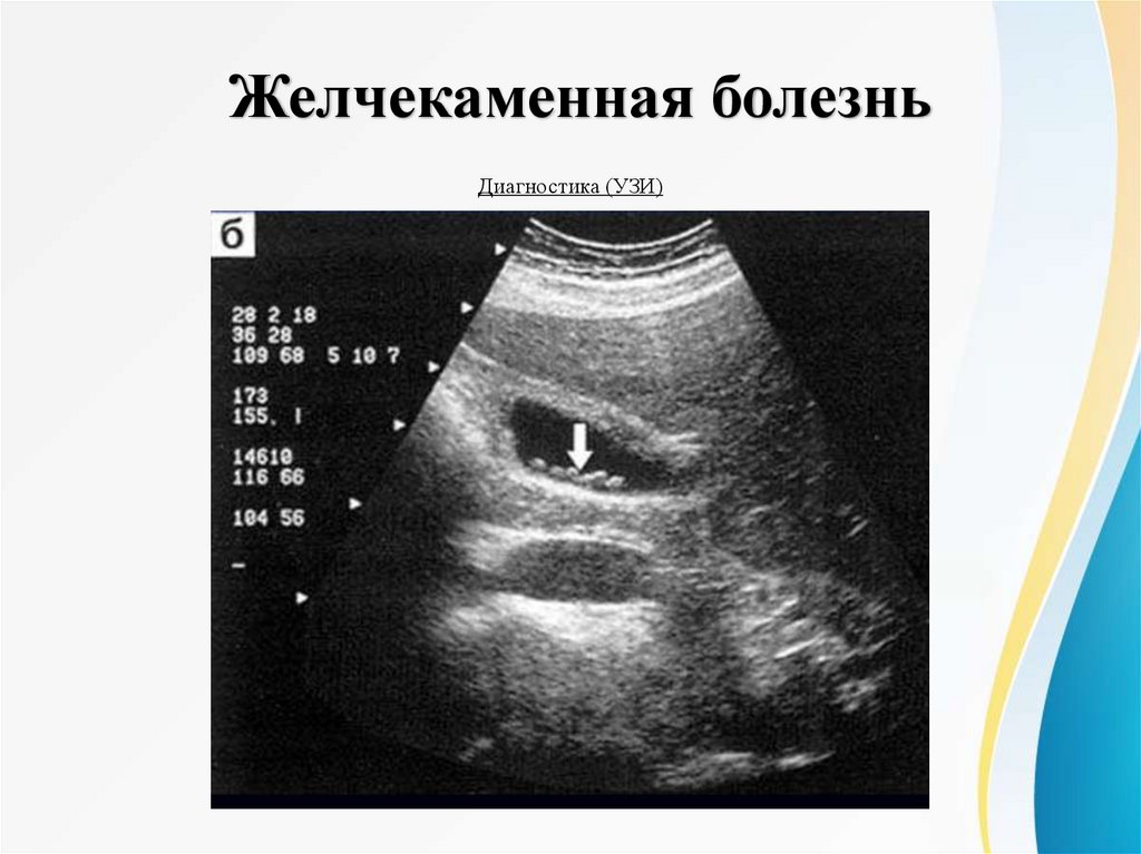 Желчекаменная болезнь