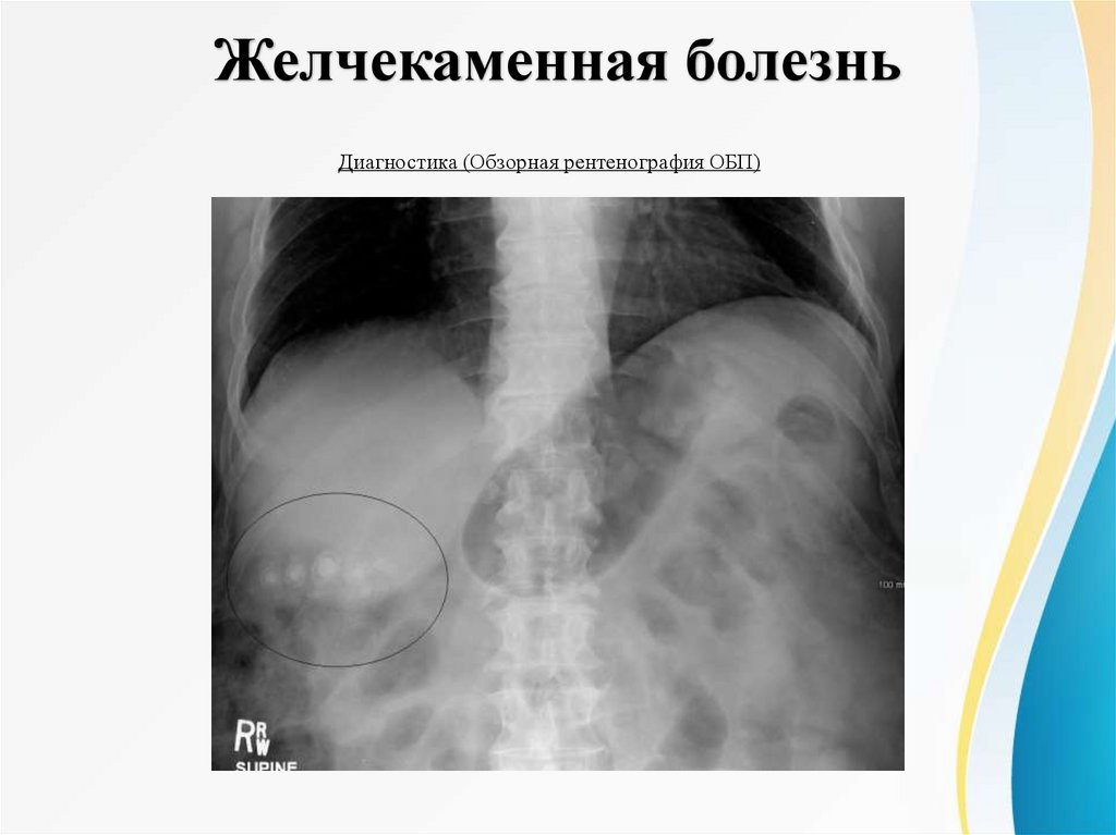 Желчекаменная болезнь