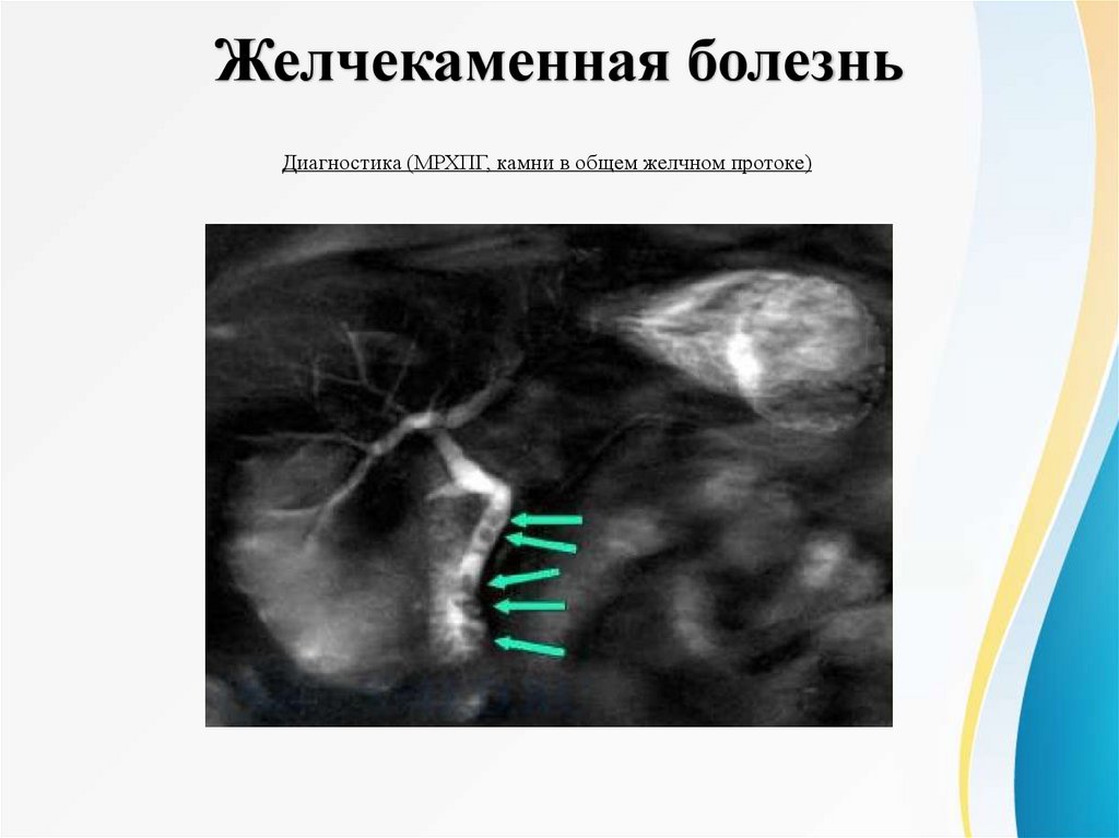 Желчекаменная болезнь
