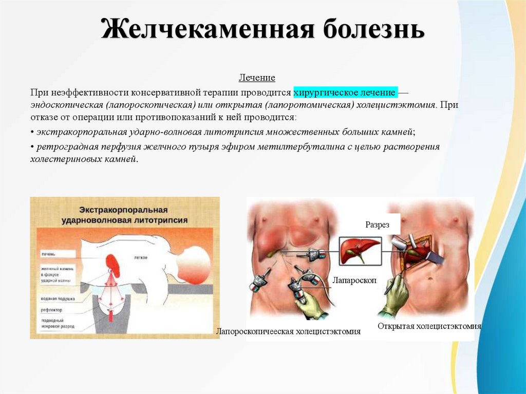 Желчекаменная болезнь