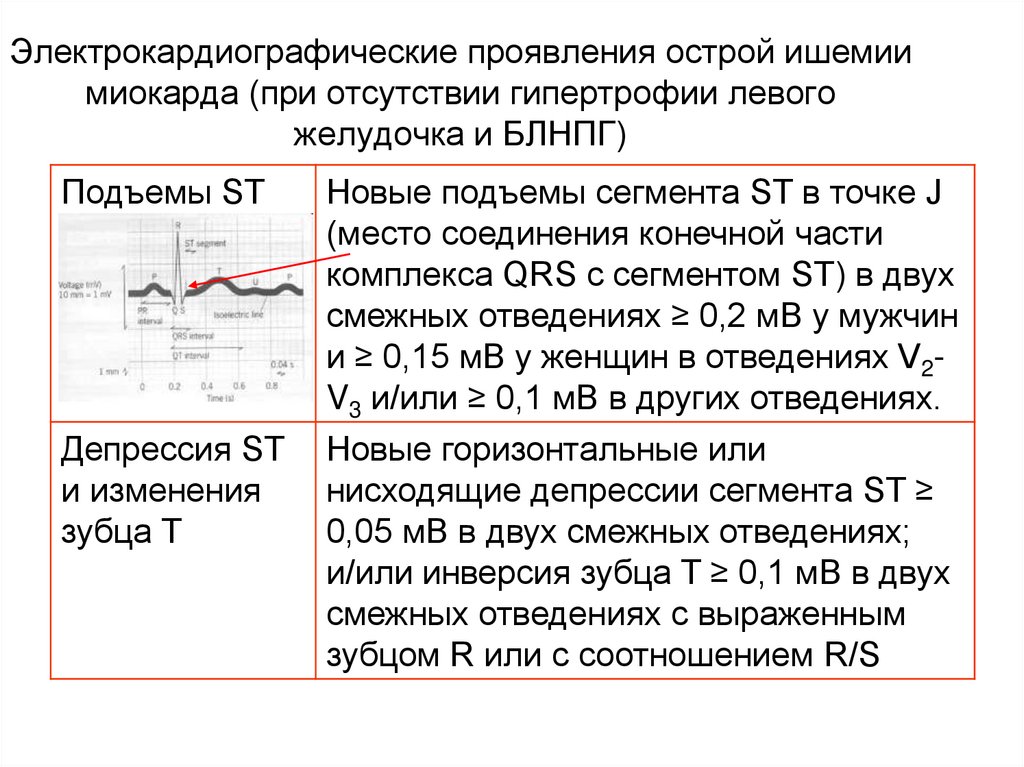 Электрокардиографические проявления острой ишемии миокарда (при отсутствии гипертрофии левого желудочка и БЛНПГ)
