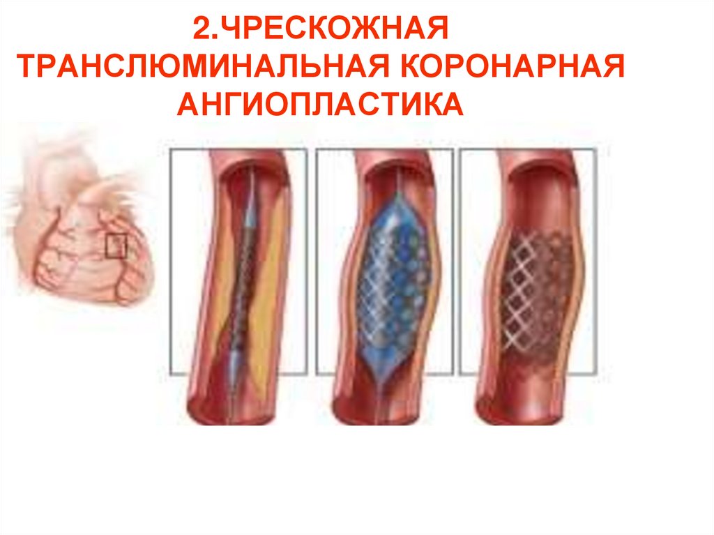 ЧРЕСКОЖНАЯ ТРАНСЛЮМИНАЛЬНАЯ КОРОНАРНАЯ АНГИОПЛАСТИКА