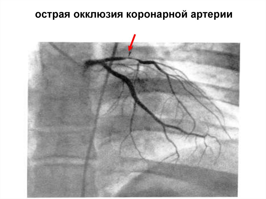 острая окклюзия коронарной артерии
