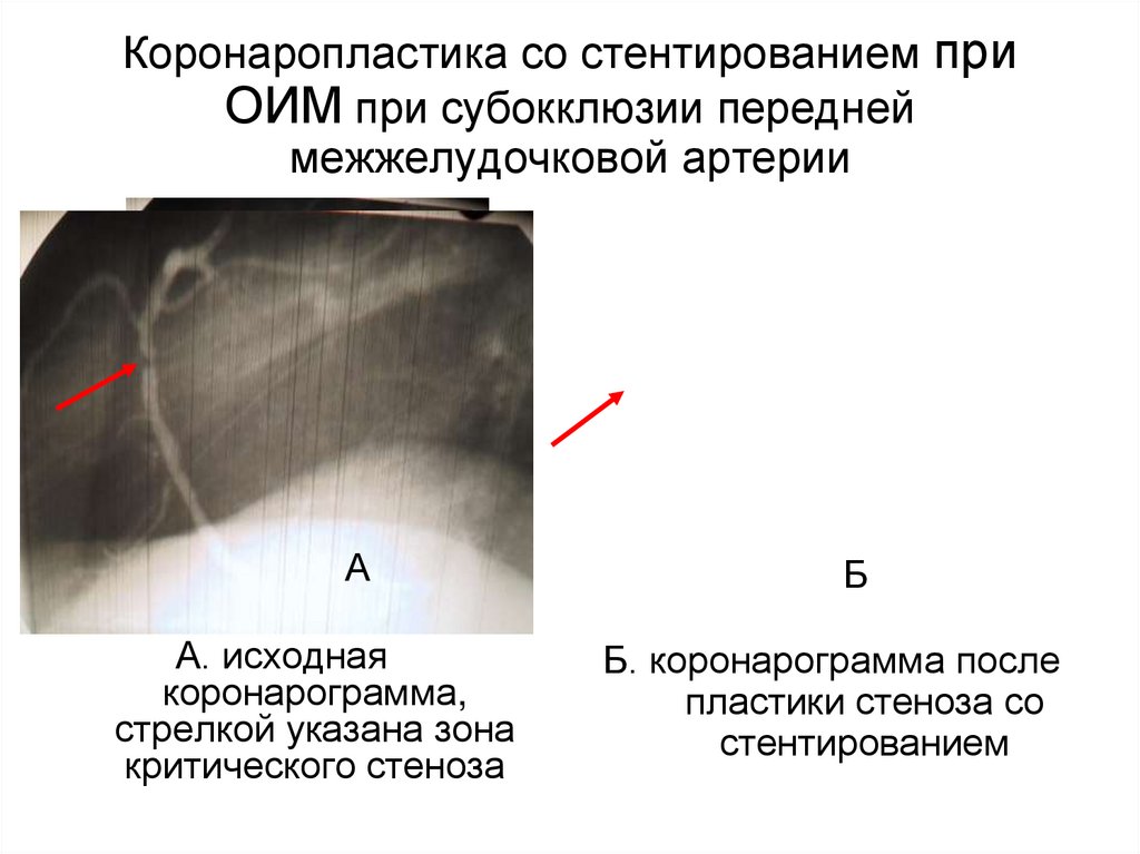 Коронаропластика со стентированием при ОИМ при субокклюзии передней межжелудочковой артерии