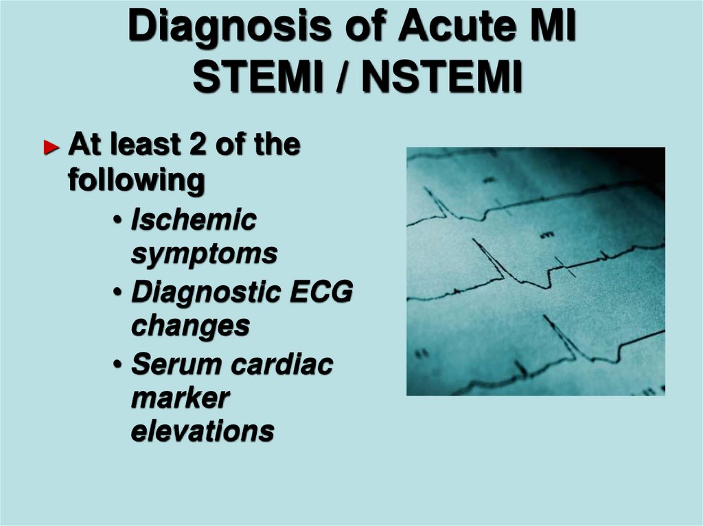 Diagnosis of Acute MI STEMI / NSTEMI