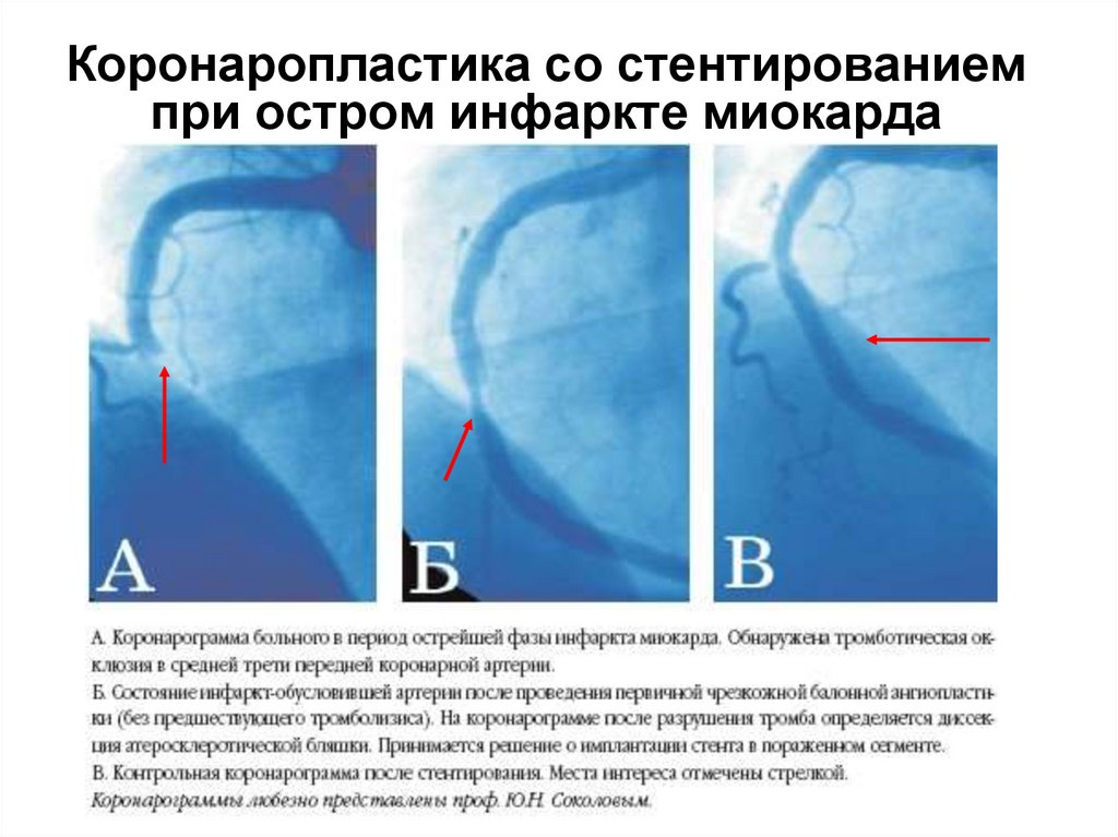 Коронаропластика со стентированием при остром инфаркте миокарда