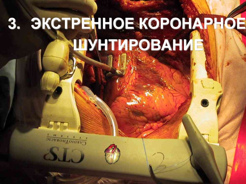 ЭКСТРЕННОЕ КОРОНАРНОЕ ШУНТИРОВАНИЕ