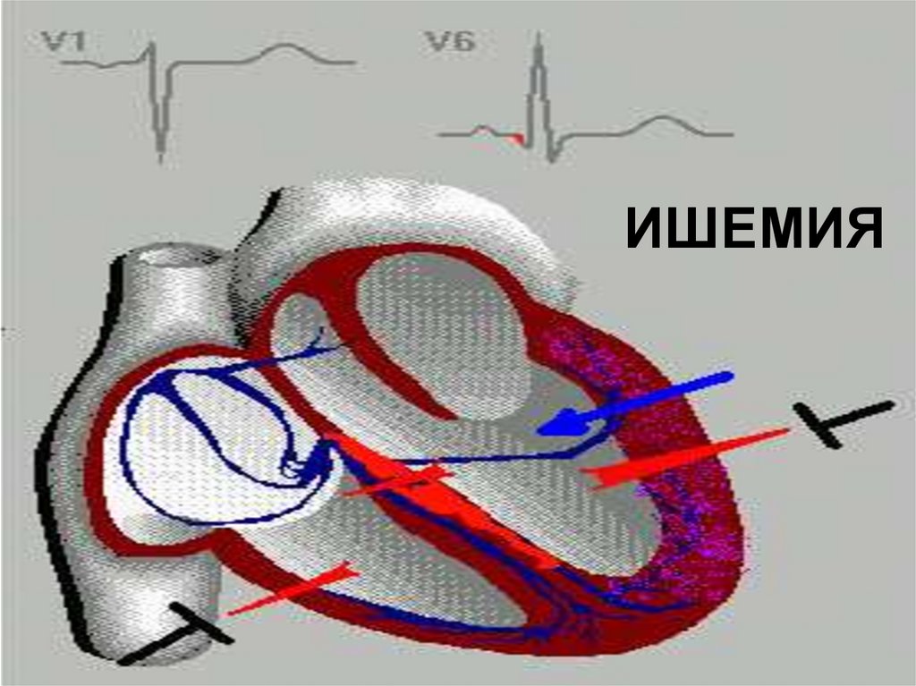 ИШЕМИЯ