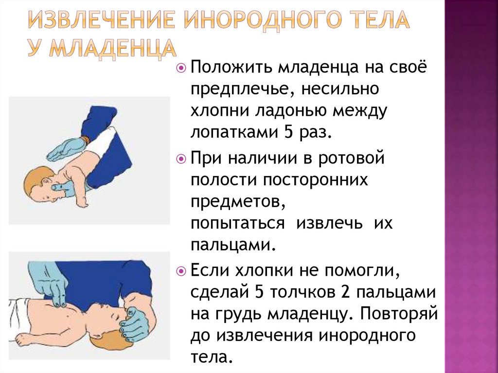 Извлечение инородного тела у младенца