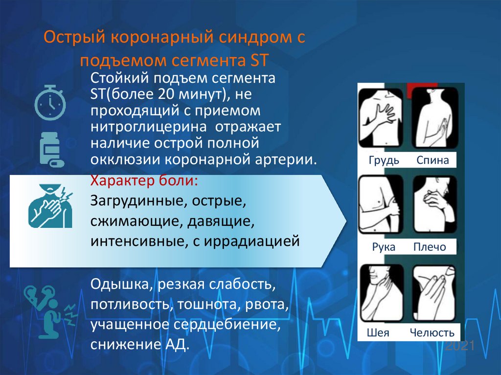Острый коронарный синдром с подъемом сегмента ST