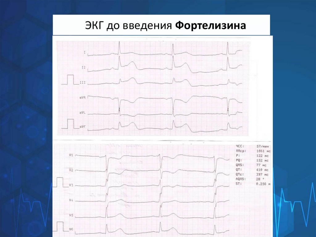 ЭКГ до введения Фортелизина